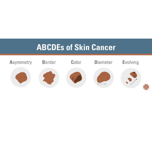 The ABCDEs of Melanoma Every Patient Should Know