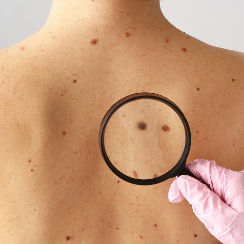 Why Annual Skin Exams Are Important for Every Age