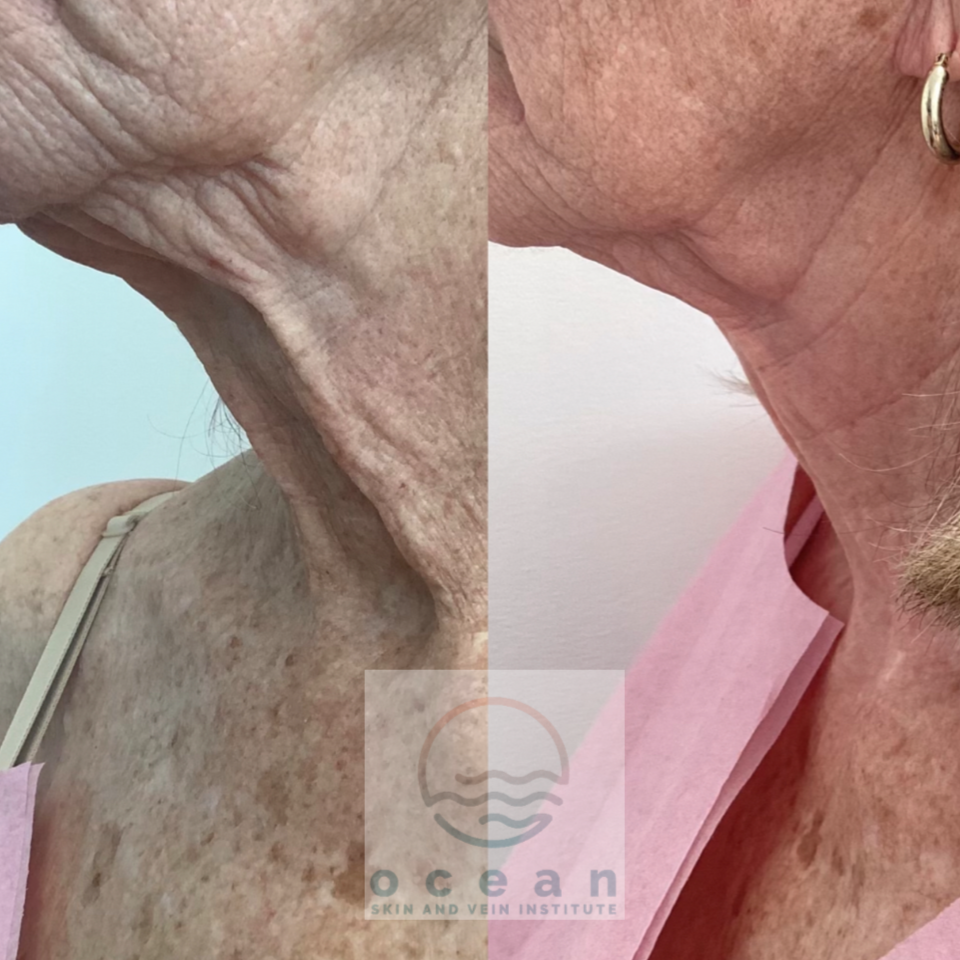 Woman with Co2 LAser
