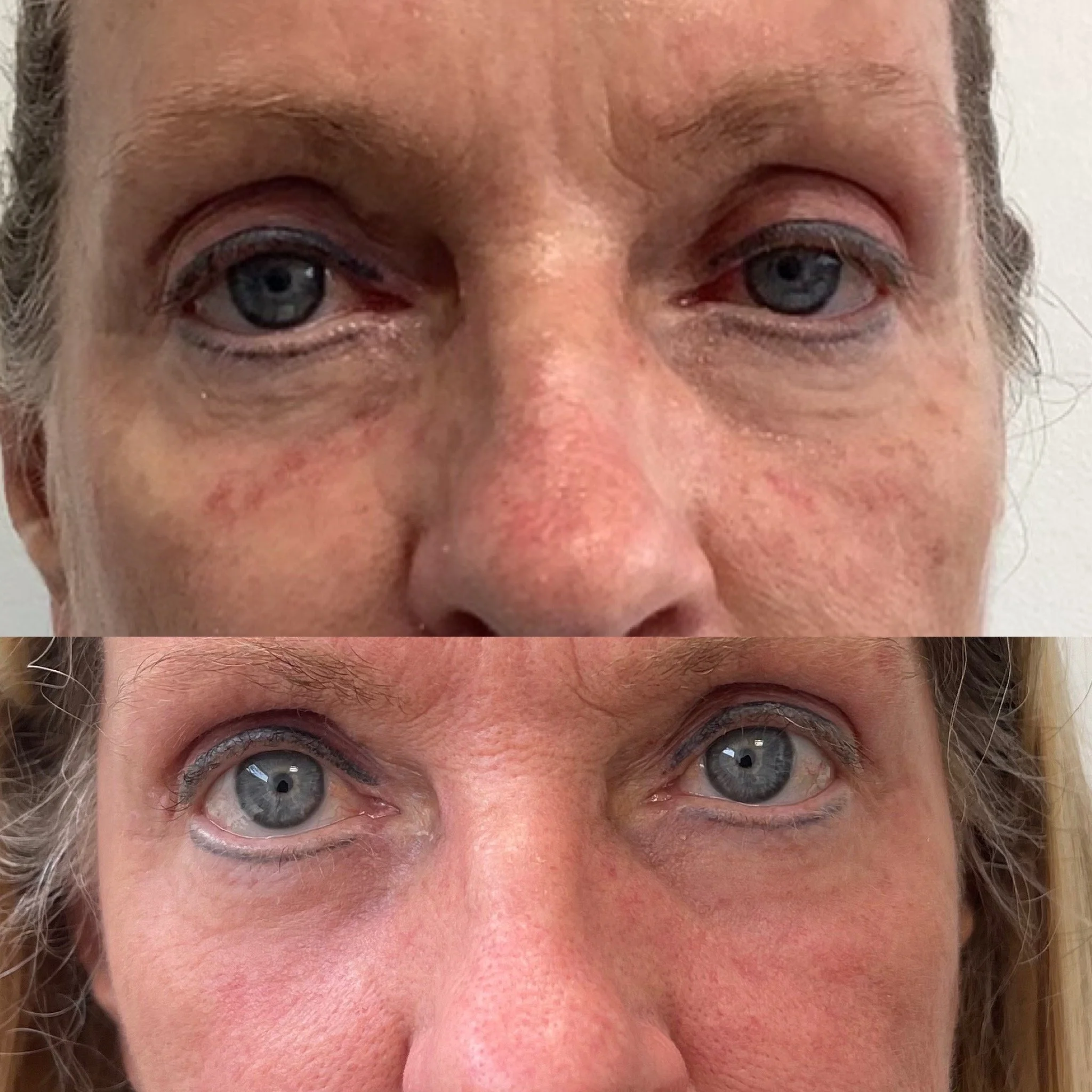 Before and after results of laser treatments
