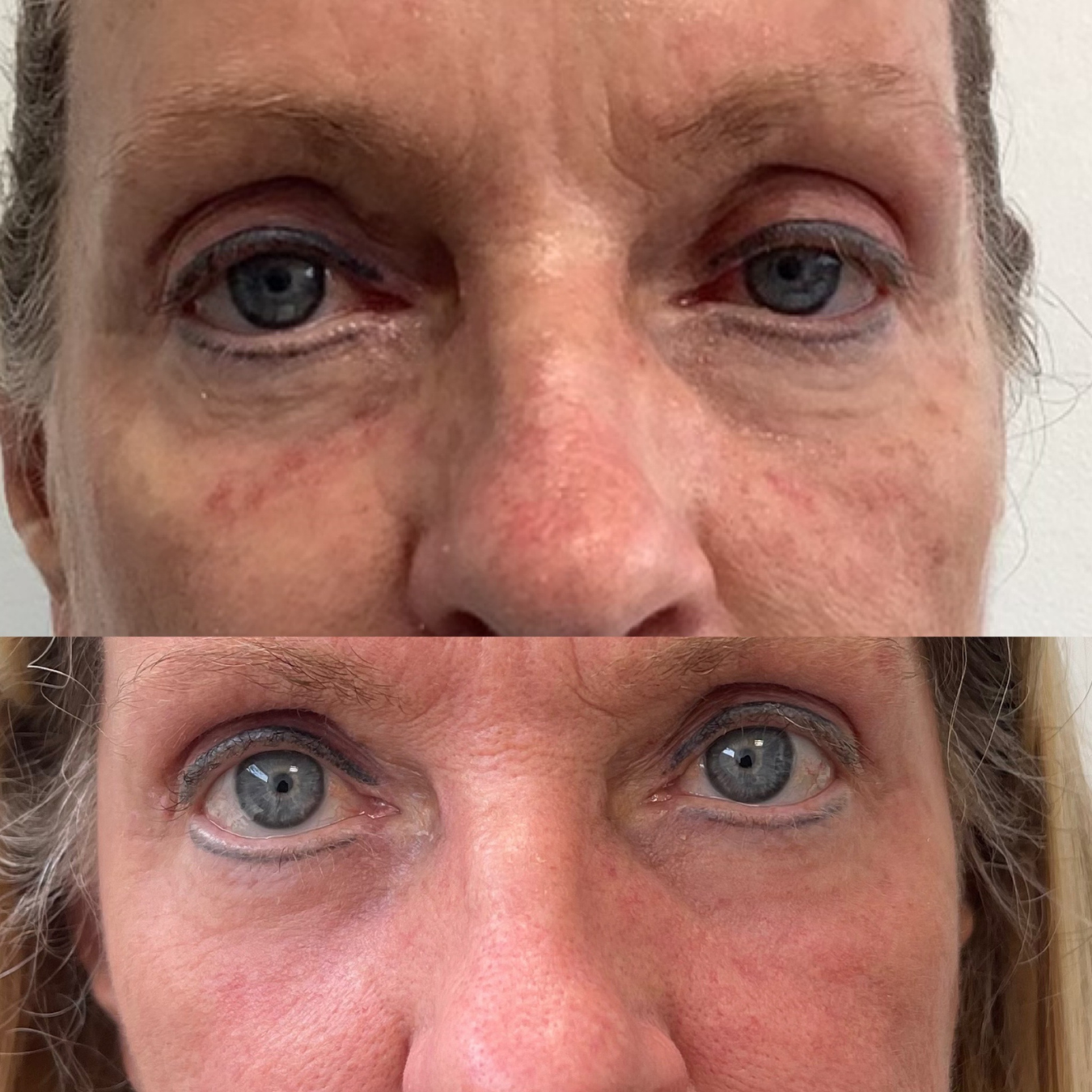 Woman with Laser treatment