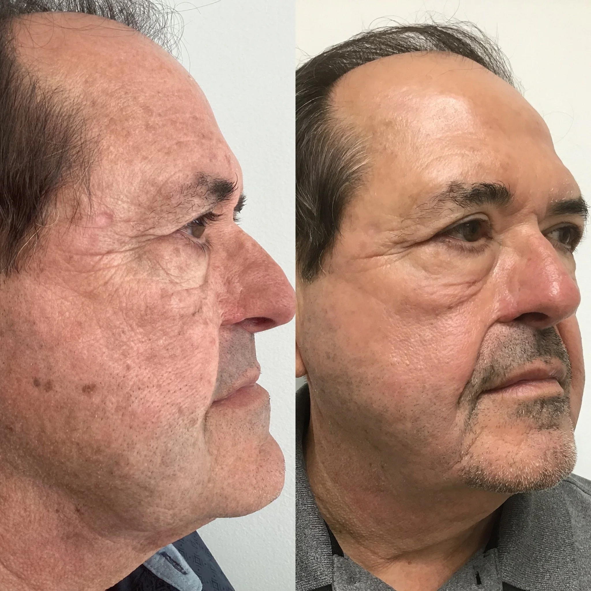 Man with face filler