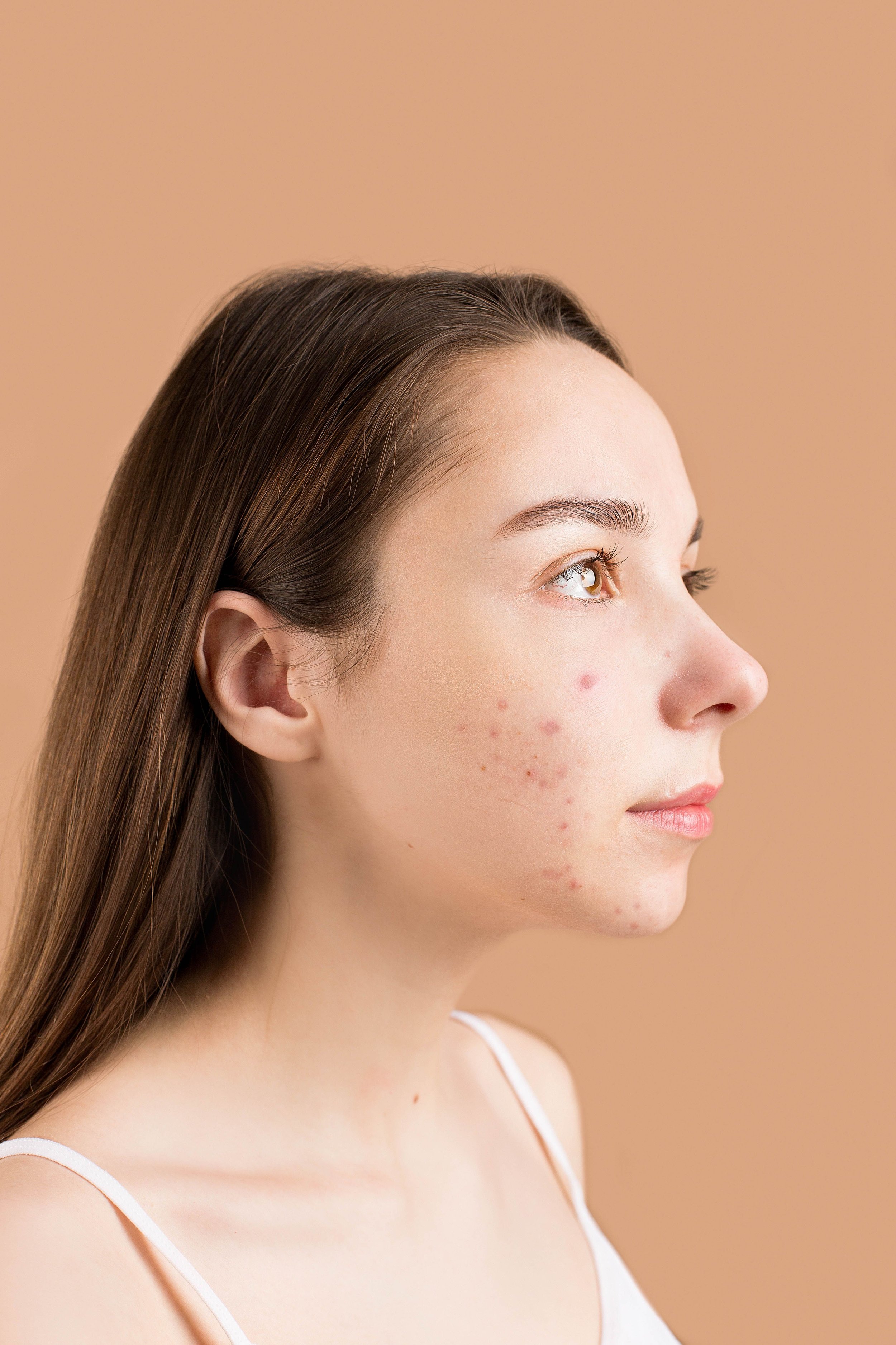 Acne and acne scar treatment provided by OSVI Cosmetic Dermatology to improve skin clarity and texture.