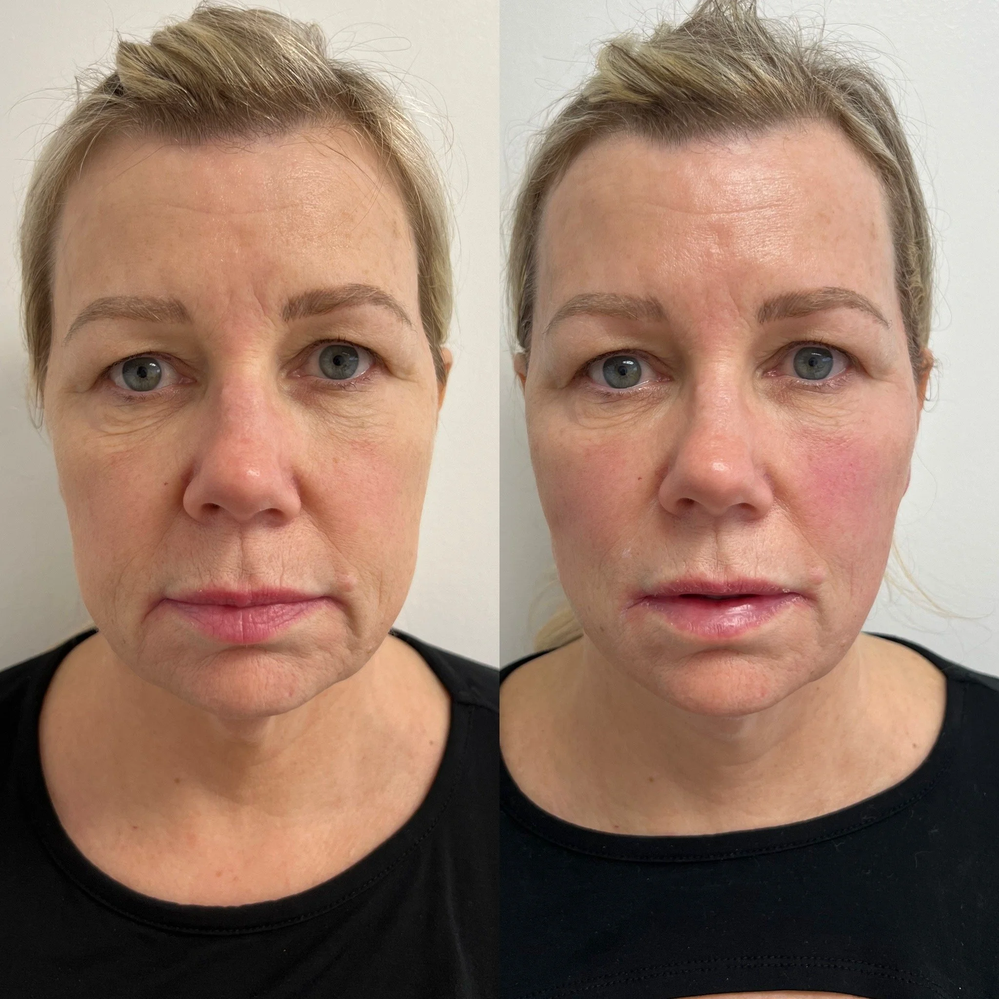 Woman before and after thread lift