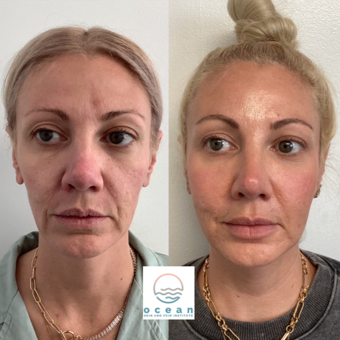 Woman with face filler