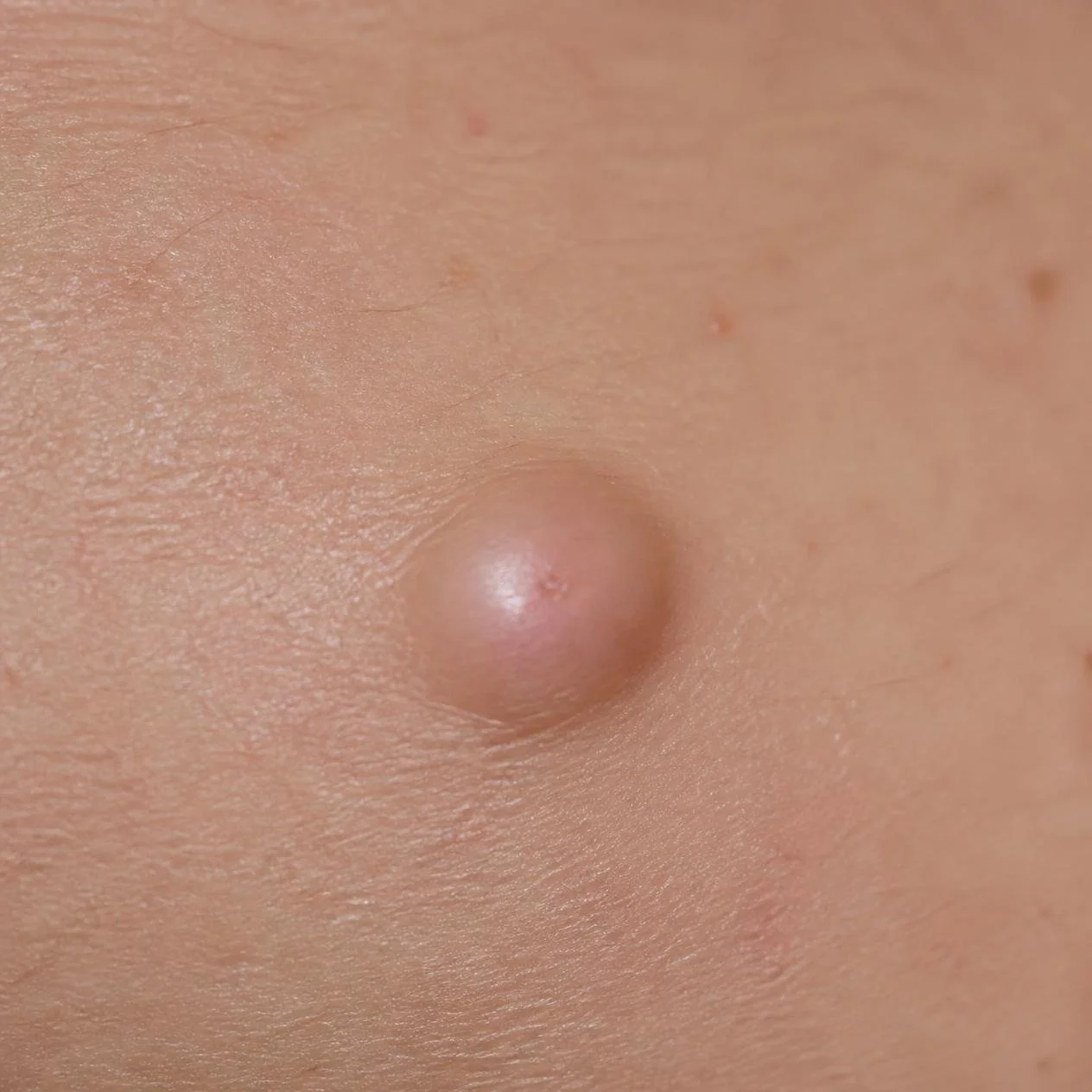 Dermatologist examining a skin cyst to determine appropriate treatment.