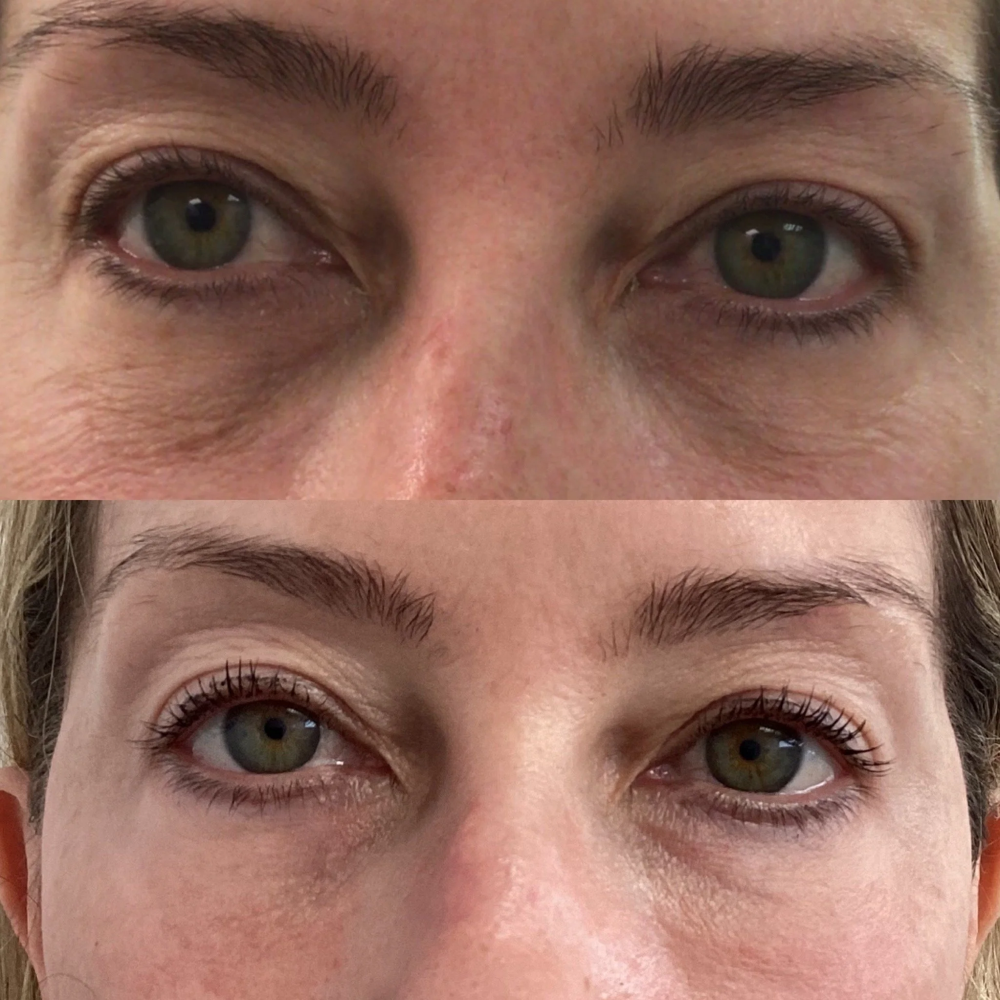 Woman with CO2 Laser