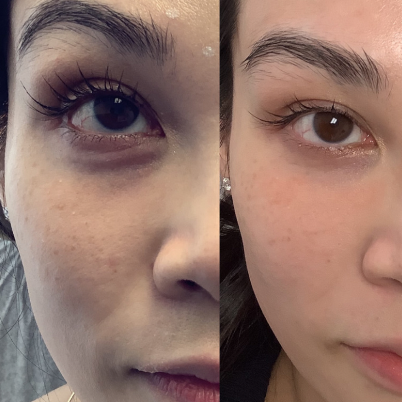 Woman with under eye filler