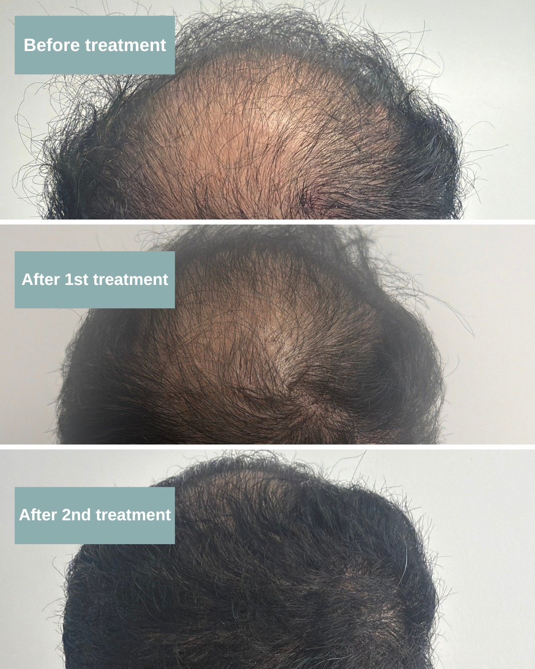Man hair before and after TED Hair Treatment