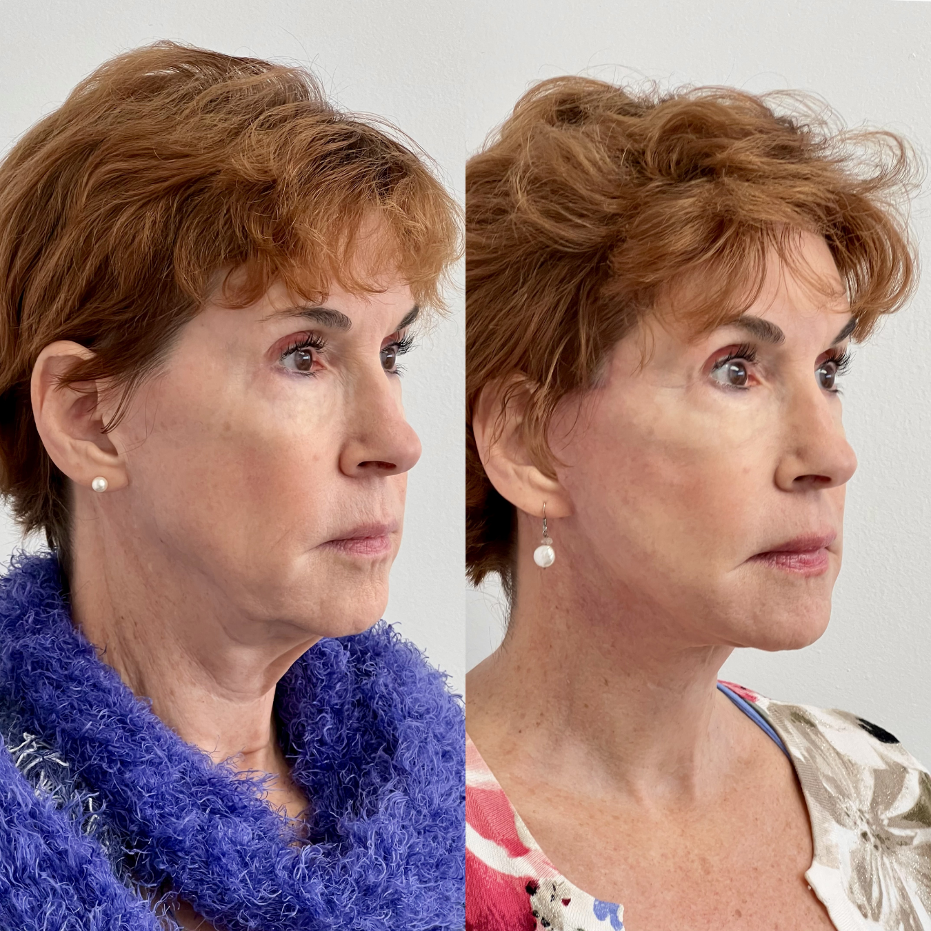 Woman with facial plastic surgery