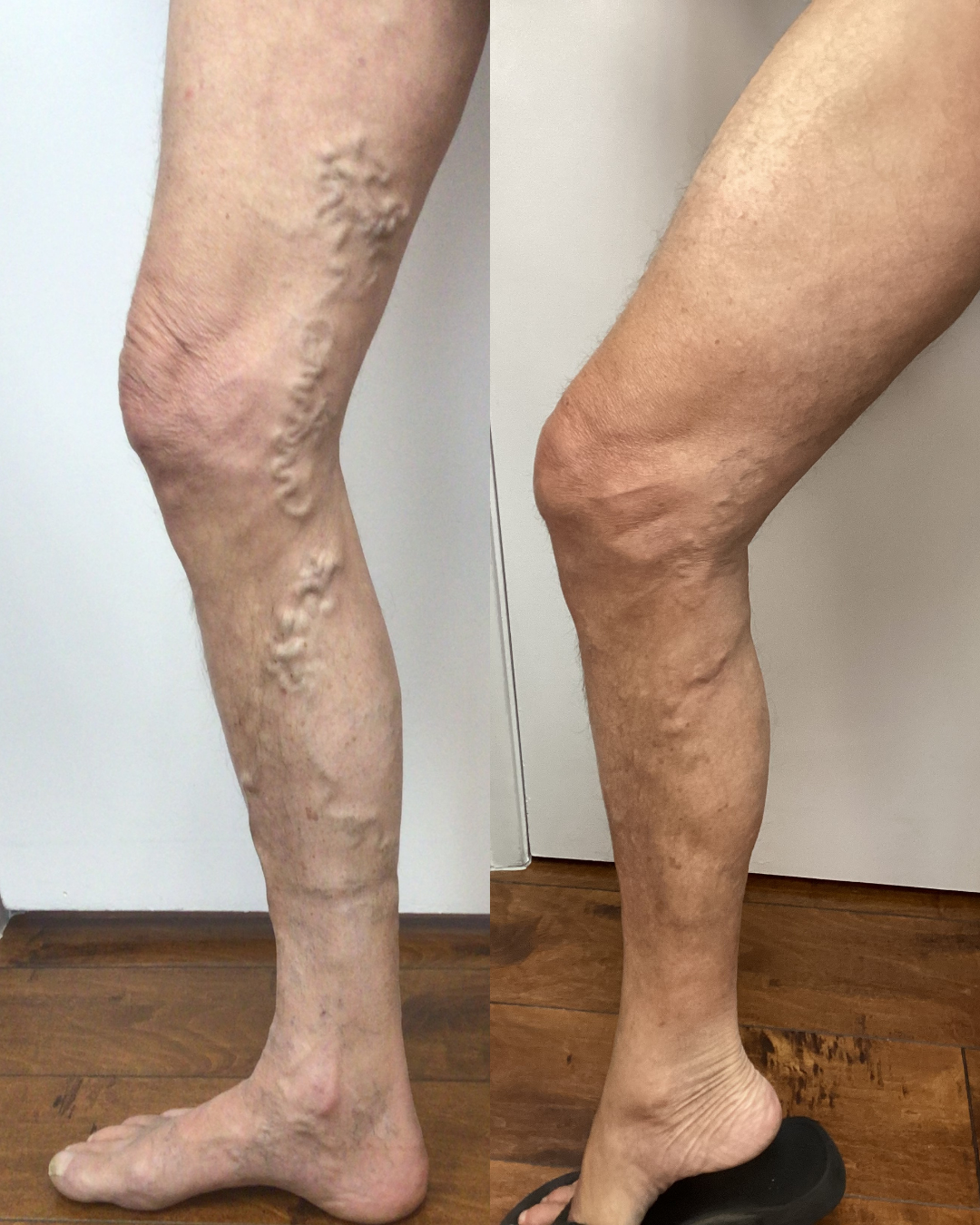 Before and after of womans veins