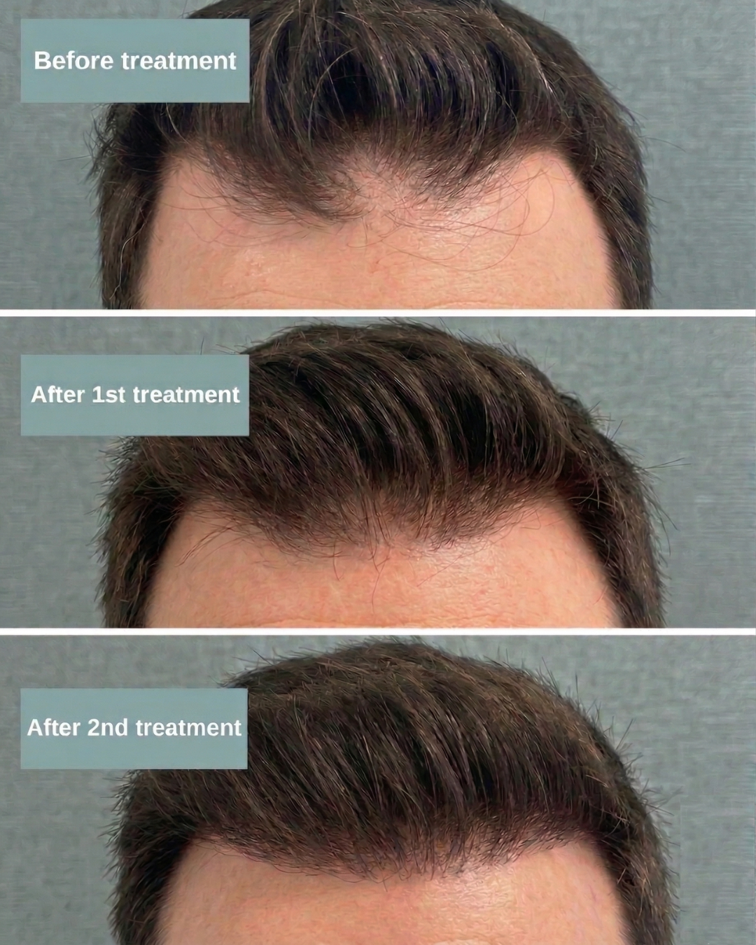 Man hair before and after TED Hair Treatment