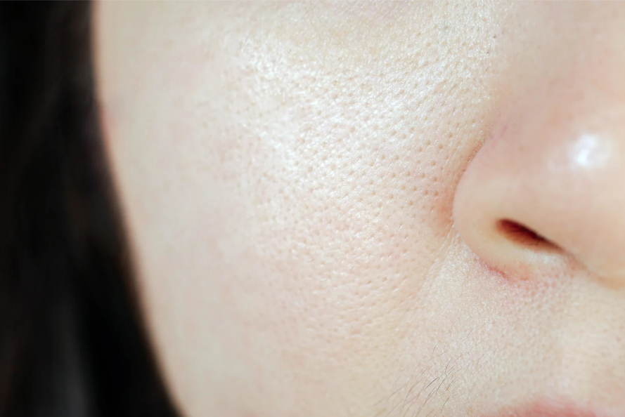Cosmetic treatment to minimize enlarged pores and improve overall skin texture.