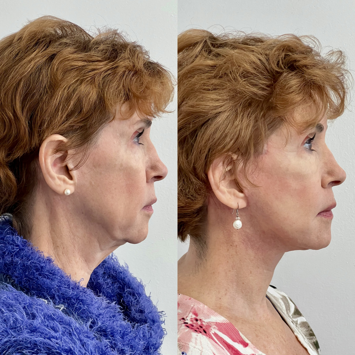 Woman with facial plastic surgery