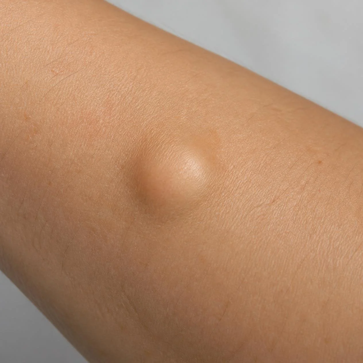 Lipoma, a benign fatty lump beneath the skin.