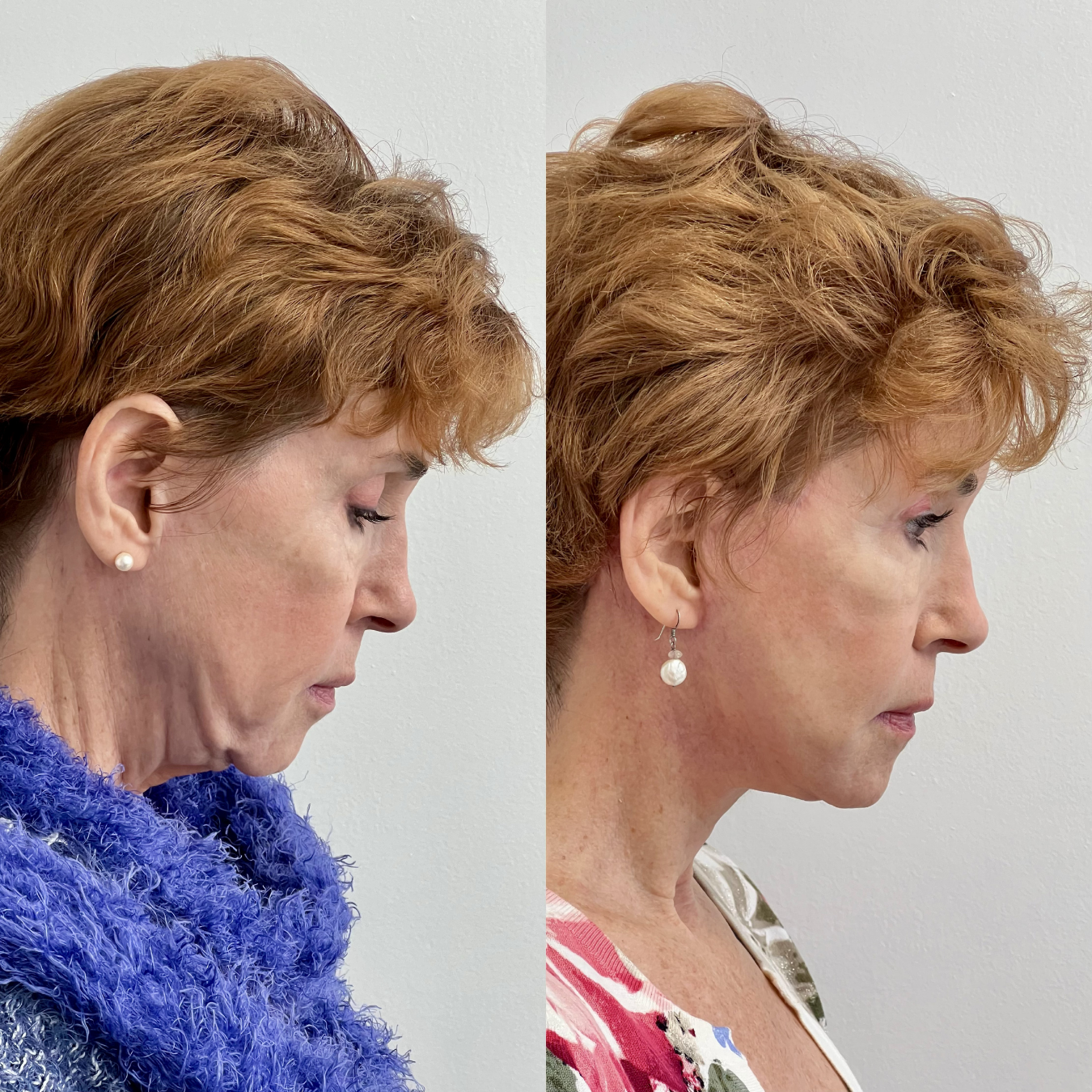 Woman with facial plastic surgery