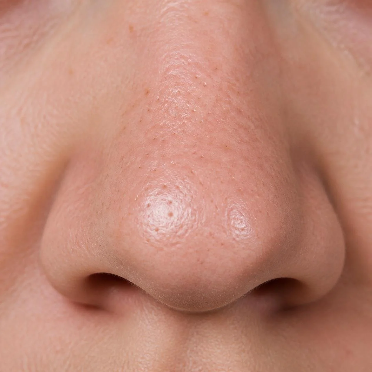 Rhinophyma, a skin condition characterized by thickened skin on the nose.