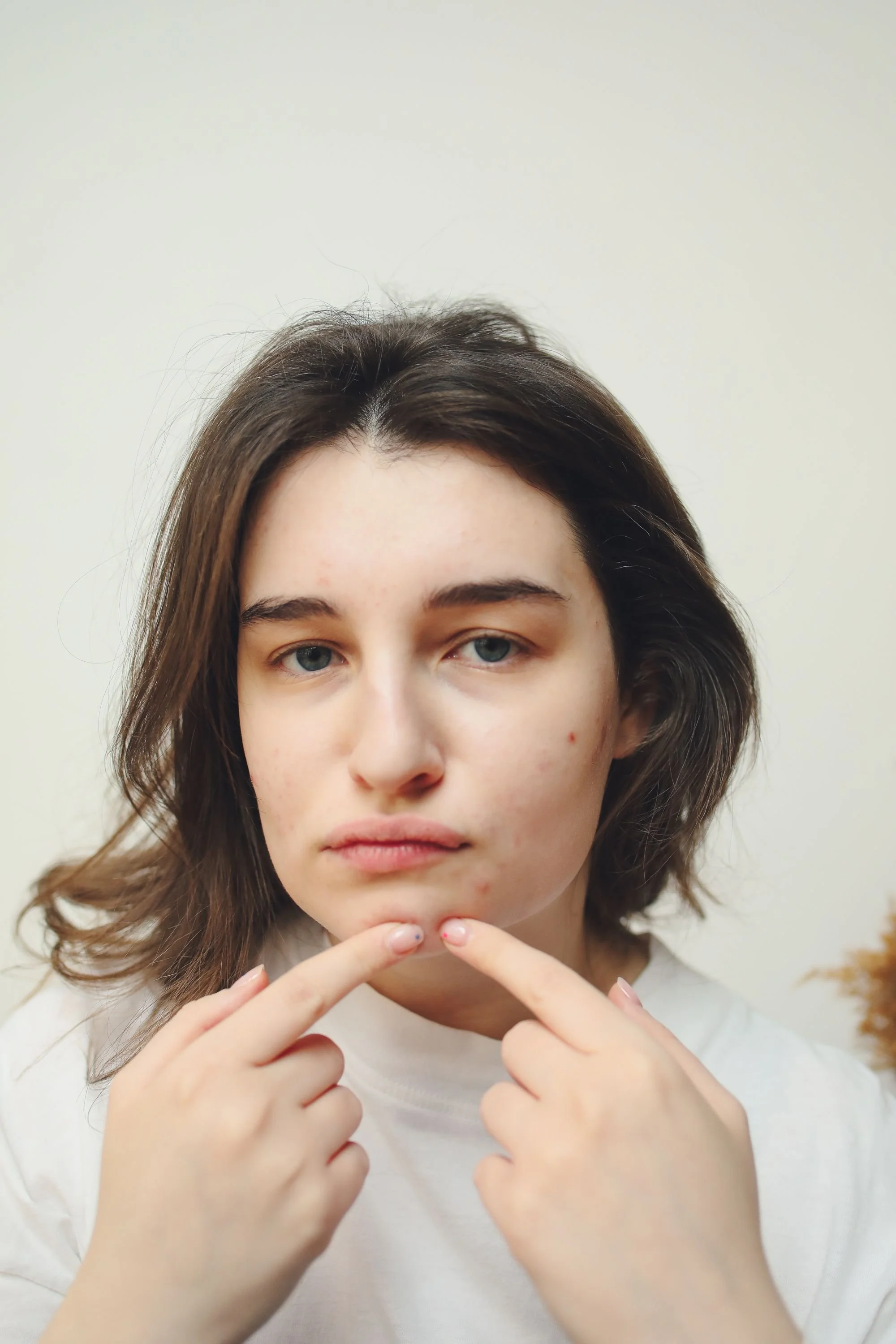 Standard Dose # Standard Dose# | Typically completed in 4-7 months and often recommended for moderate to severe acne. It generally clears acne more quickly but may come with more noticeable side effects, such as dry skin and lips.