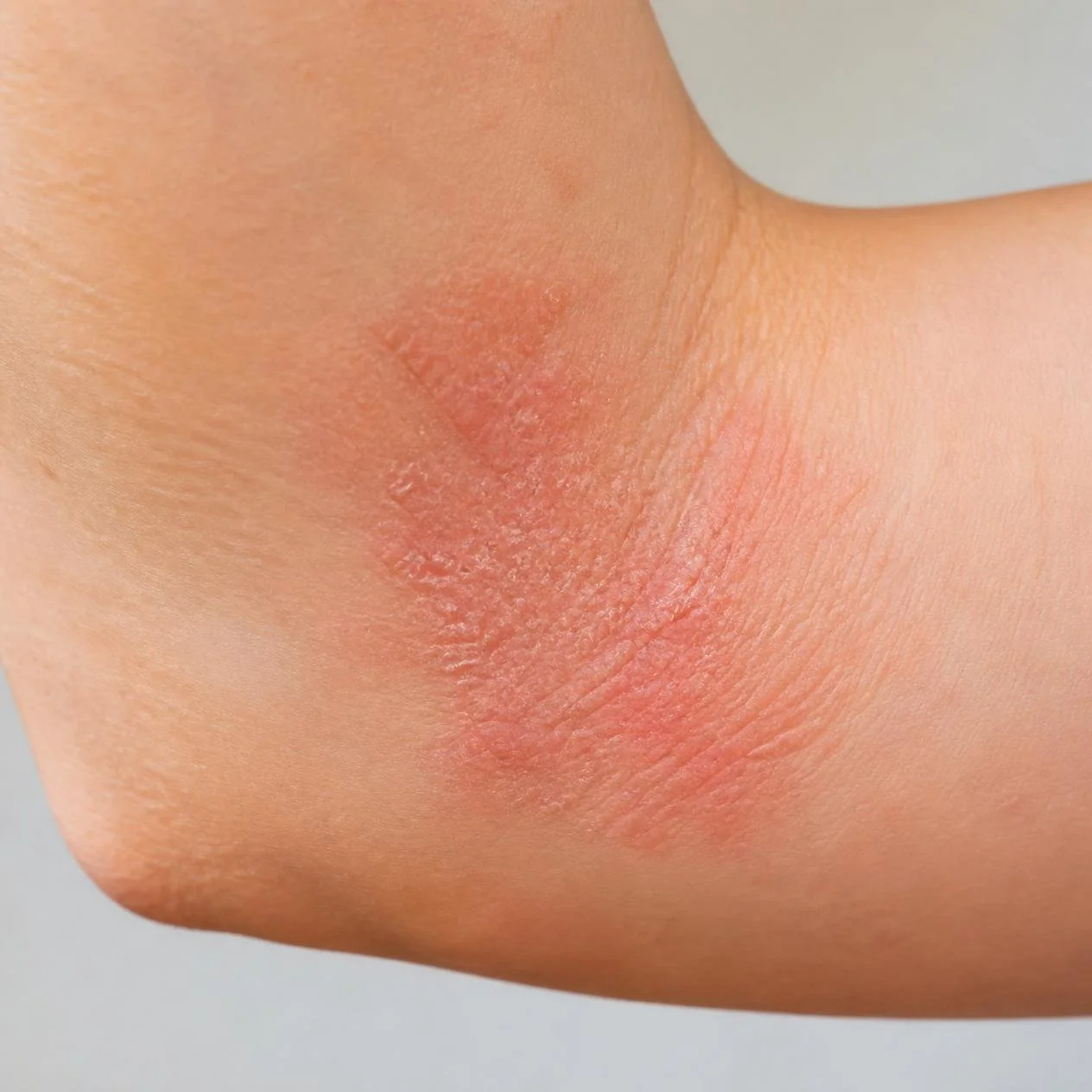 Eczema causing dry, irritated skin evaluated by a dermatologist.
