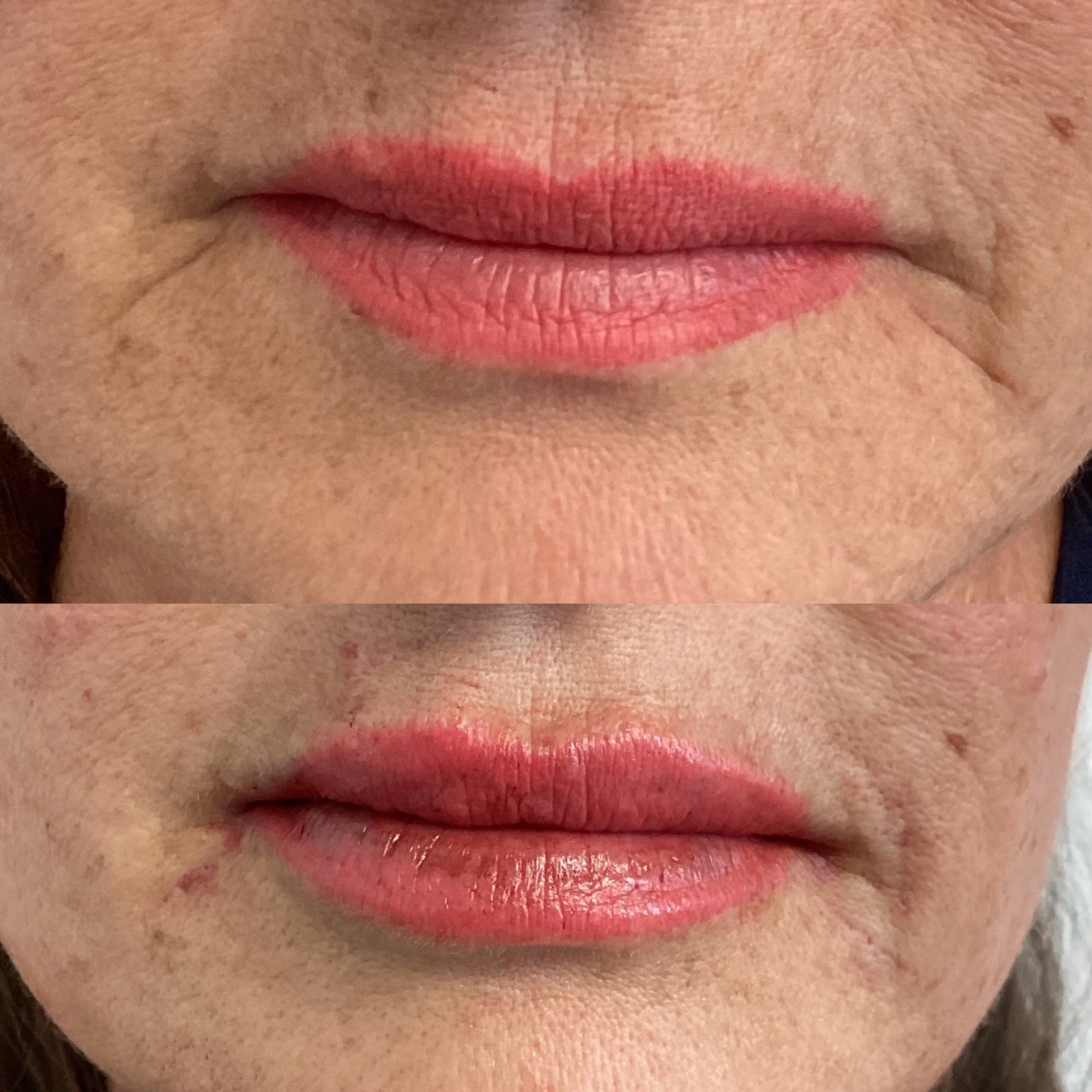 Woman with lip filler