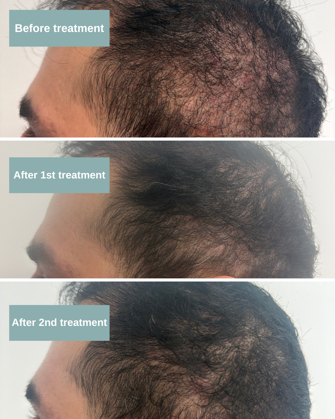 Man hair before and after TED Hair Treatment
