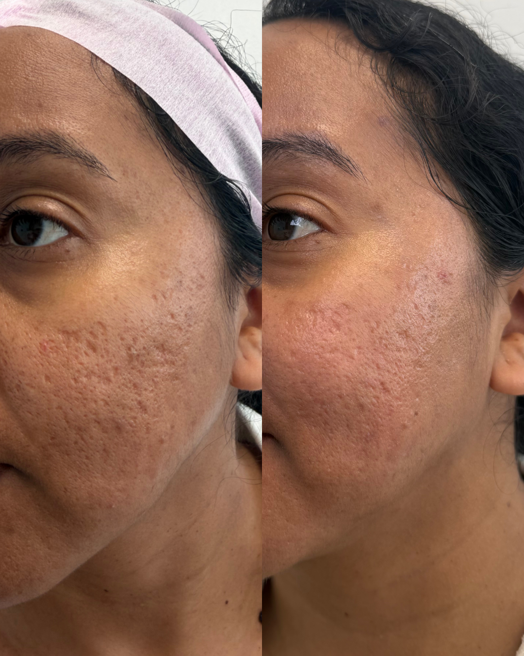 Before and after of a woman after acne surgery