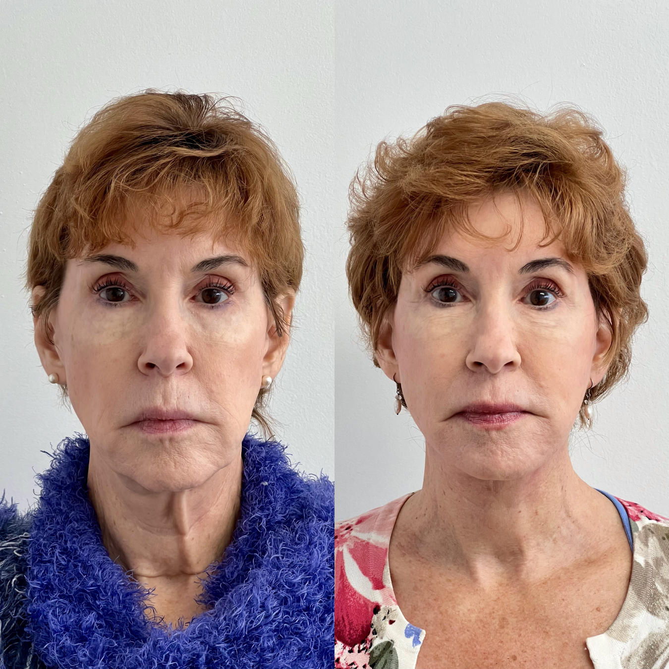 Woman with facial plastic surgery