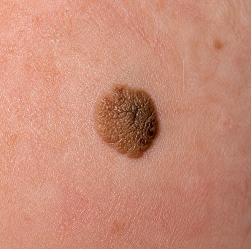 Seborrheic keratosis, a benign skin growth with a raised, waxy appearance.