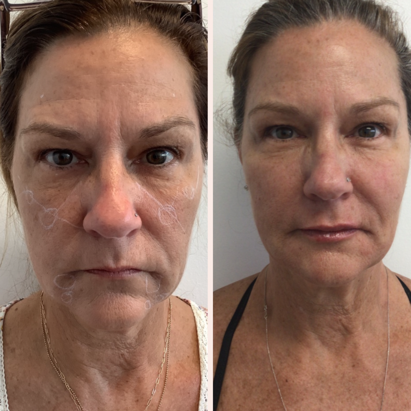 woman with face filler