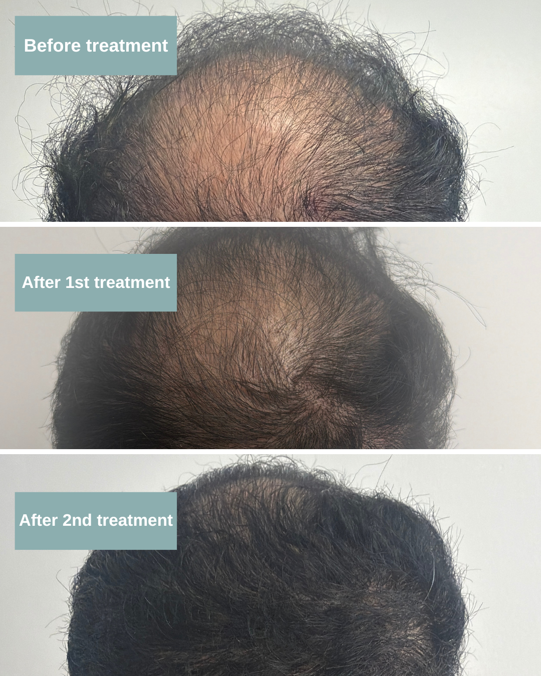TED Hair Growth Treatment | Needle-Free Hair Restoration | OSVI ...