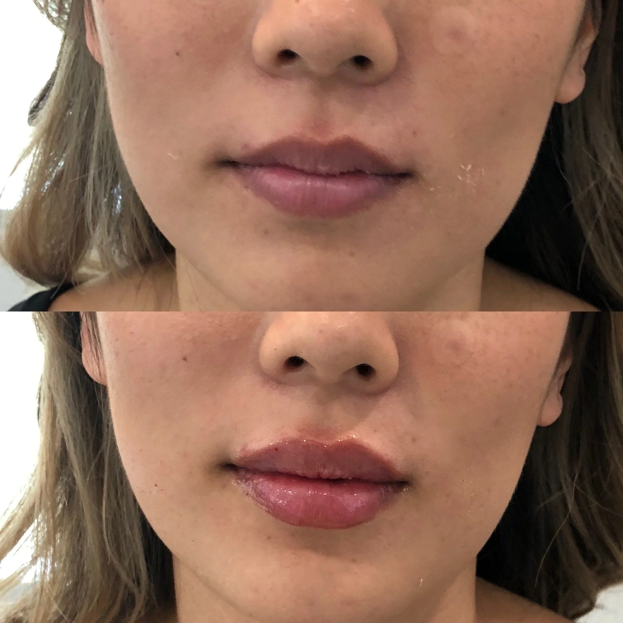 Before and after of a woman after lip filler