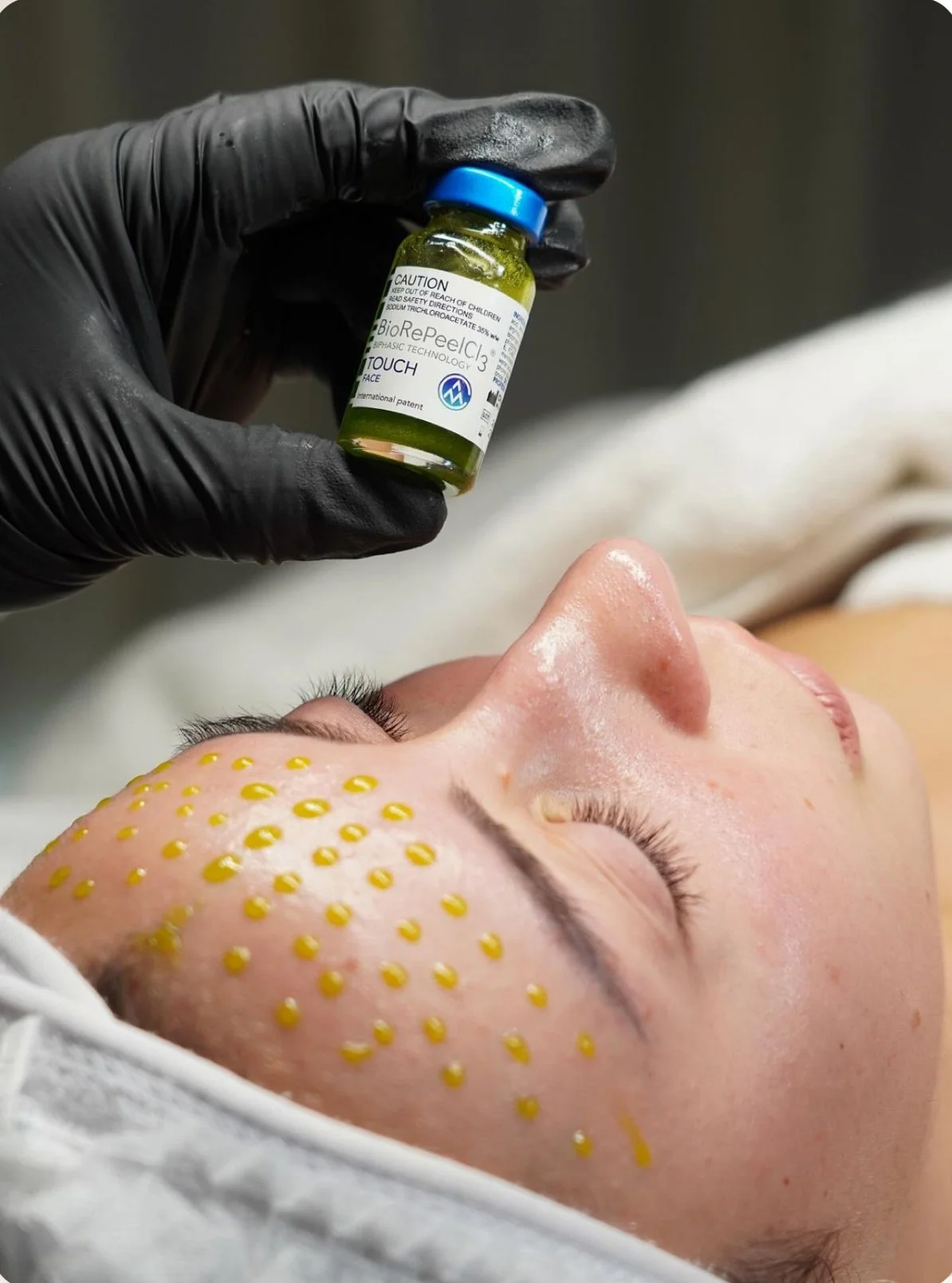 No-downtime BioRePeel chemical peel treatment in Miami medical spa