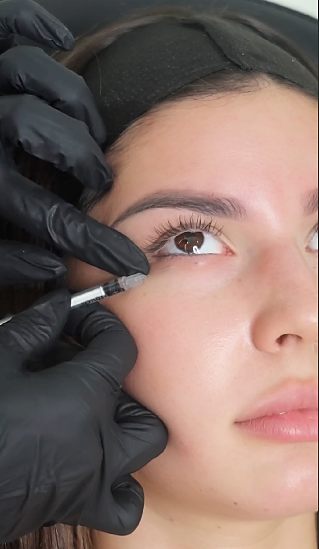 Crow’s feet and under-eye wrinkle Botox treatment in Miami med spa
