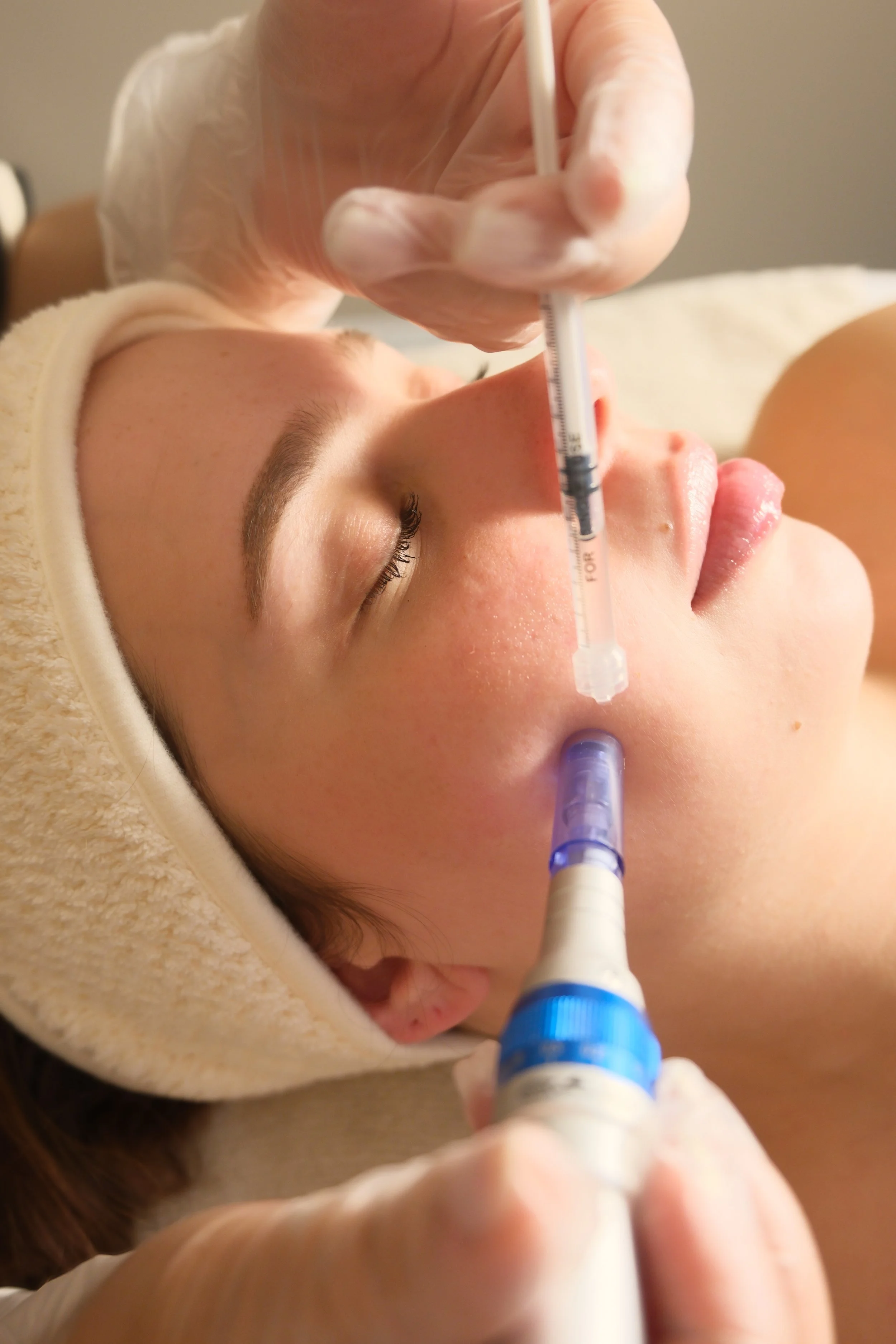 Tranexamic acid microneedling for pigmentation and brightening in Miami
