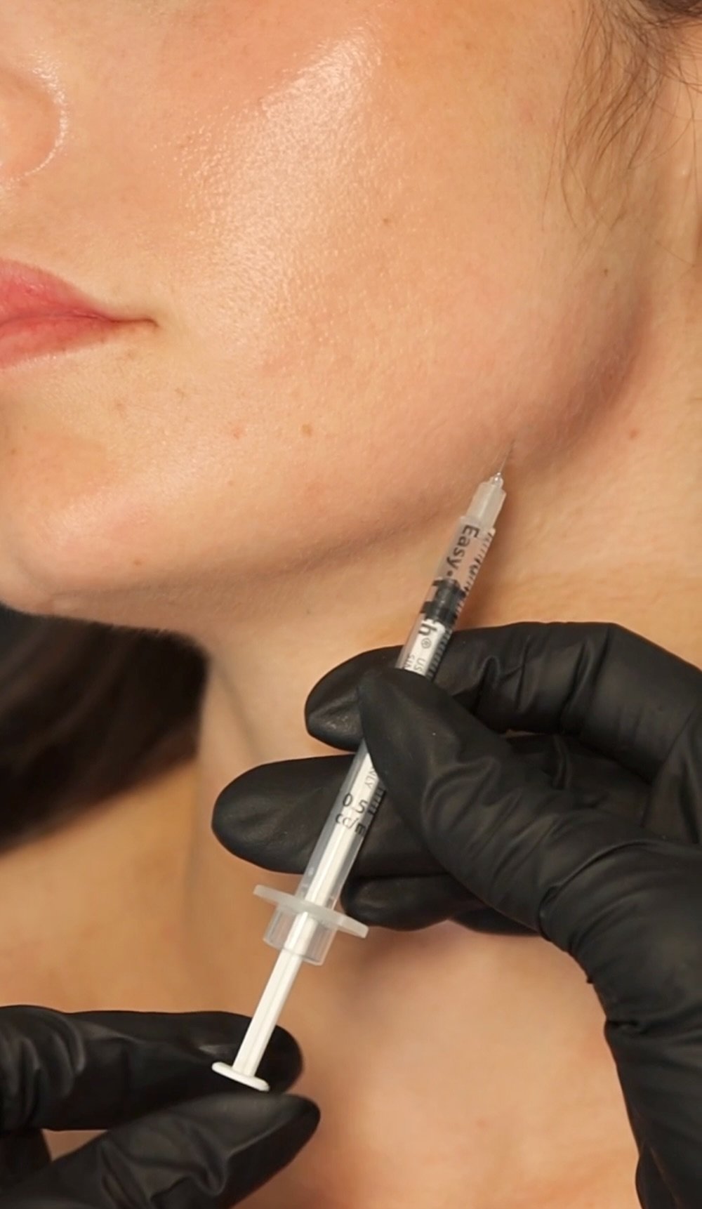 Nefertiti Lift neck bands Botox treatment in luxury Miami medical spa