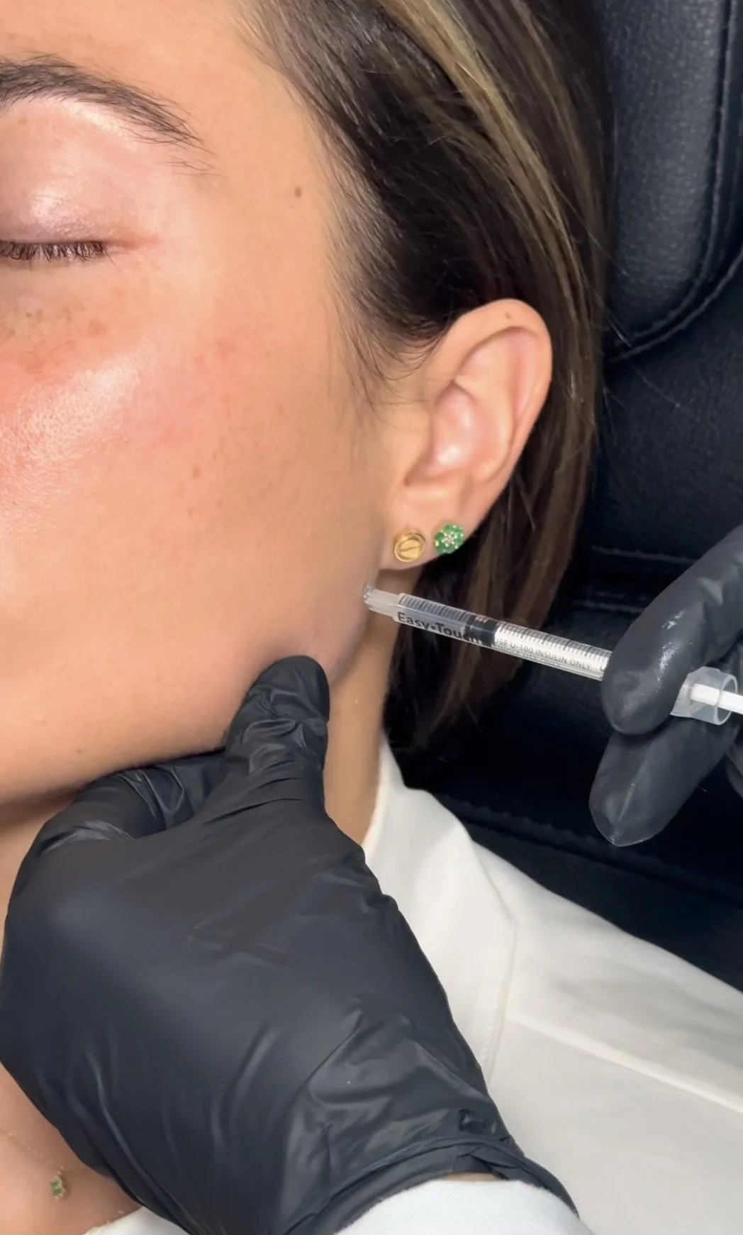 Marionette lines TMJ masseter and jawline slimming botox in Brickell