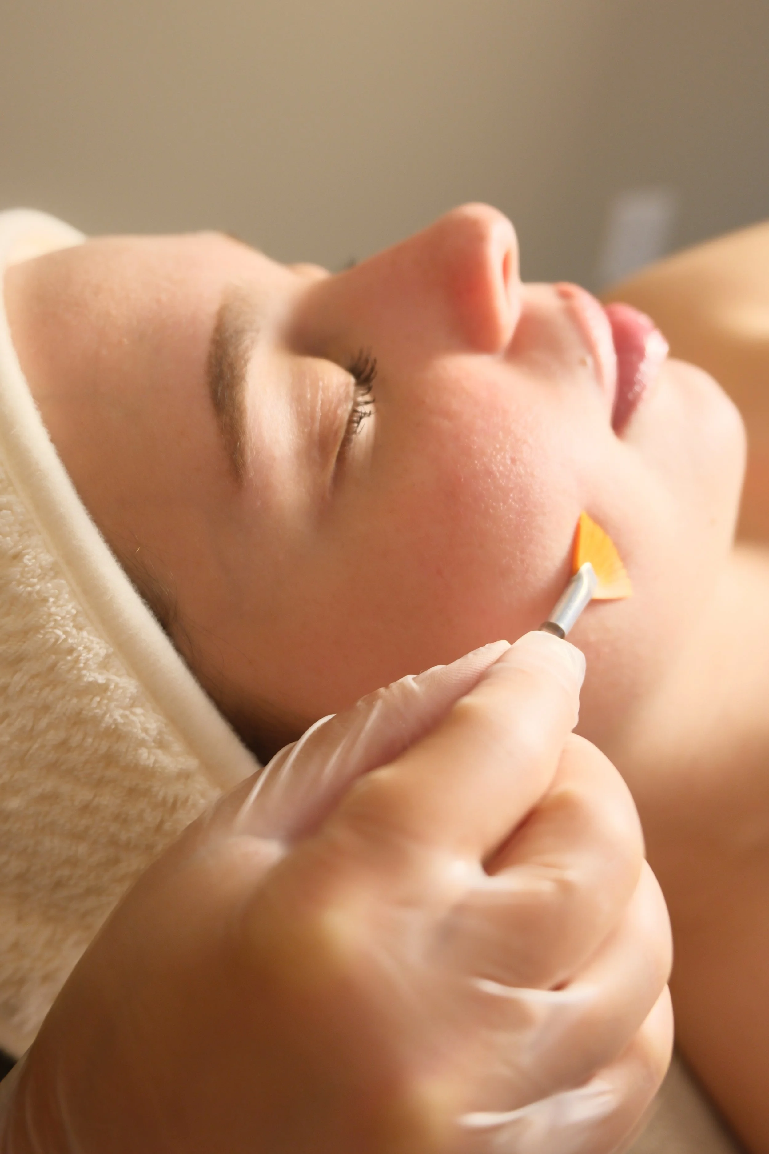 TCA chemical peel for pigmentation and texture in Miami med spa