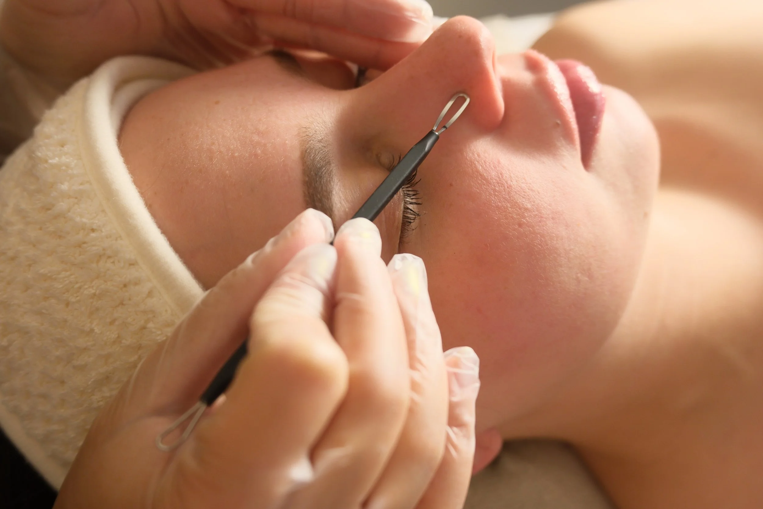 Acne deep cleansing facial for breakouts and oily skin in Brickell Miami