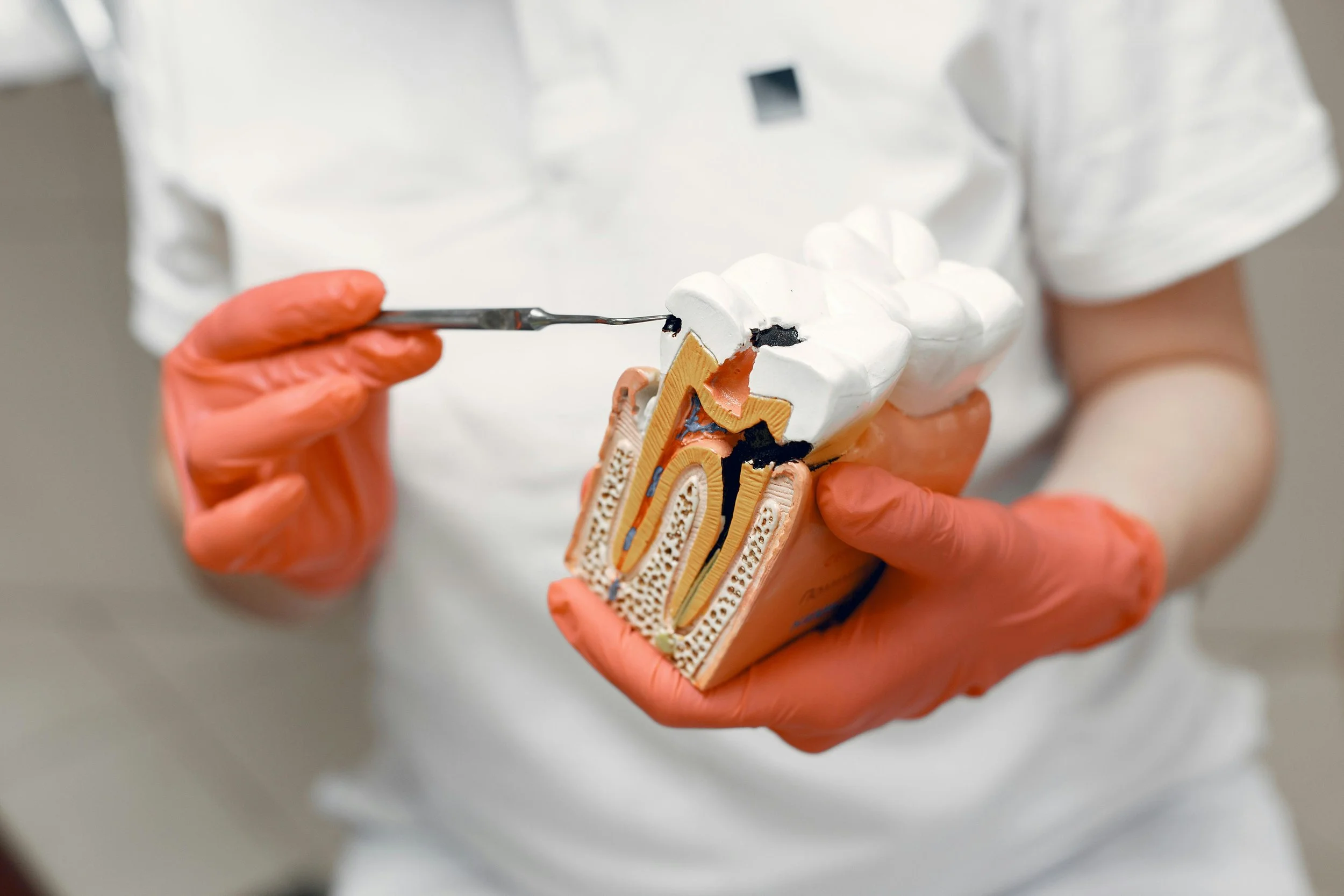 Close up of a dentist showing tooth decay on a dental model.