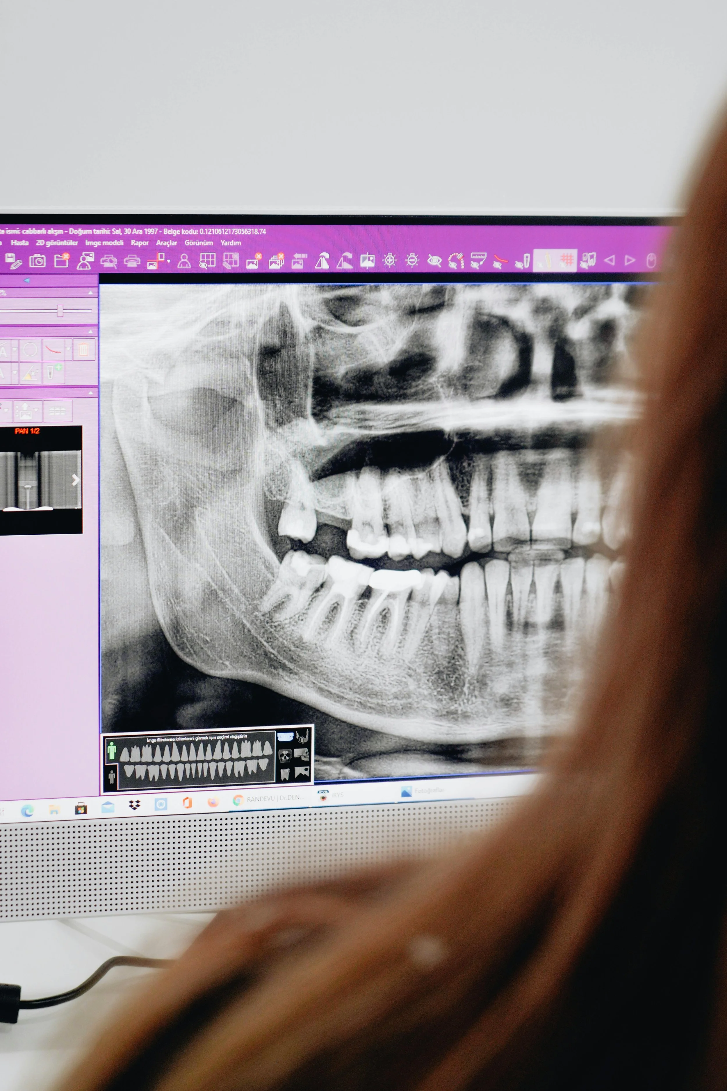 Xray of patients teeth
