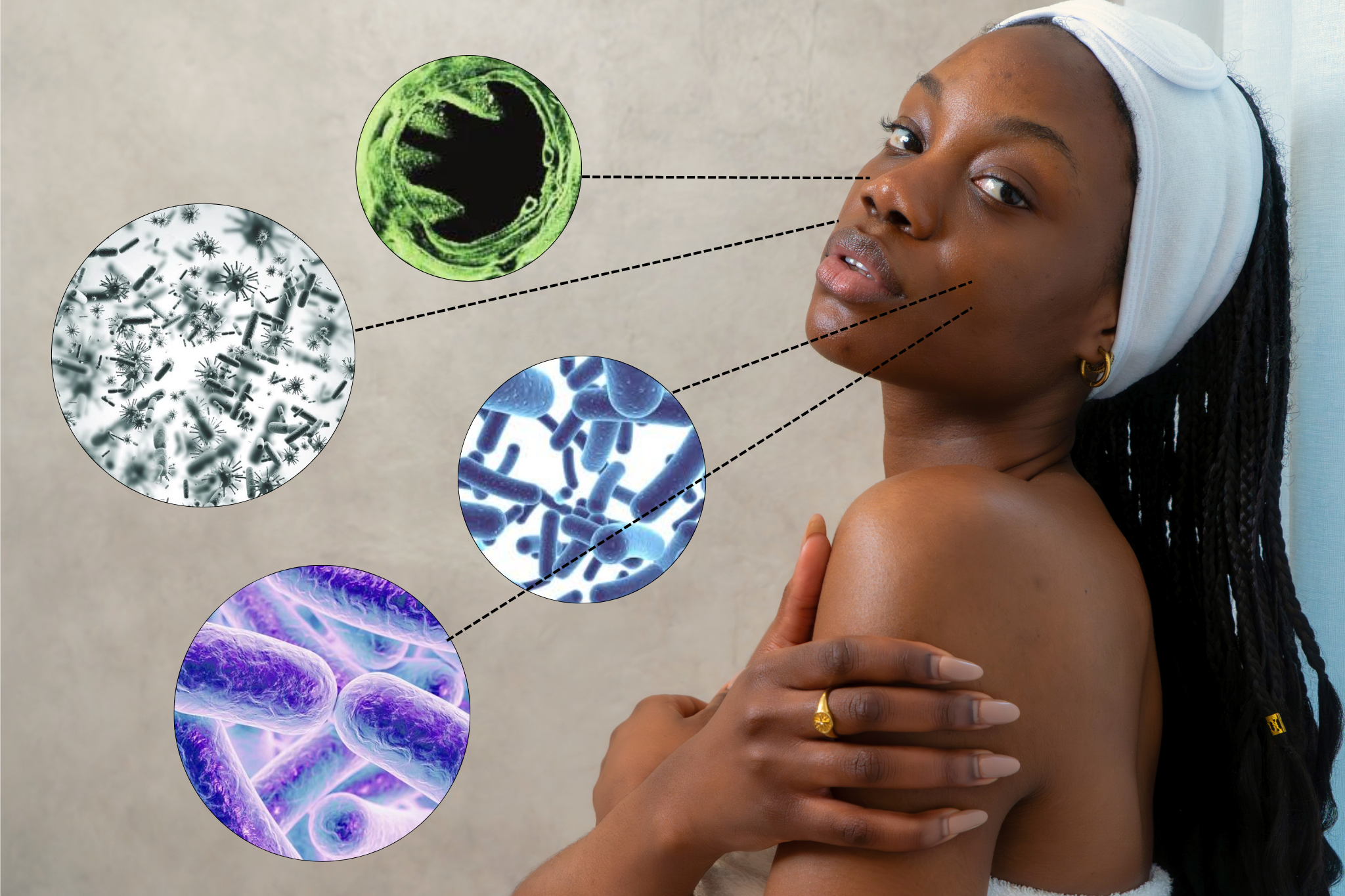 Skin Microbiome and Barrier Repair for Breakouts and Sensitive Skin; Lady skin microbiome