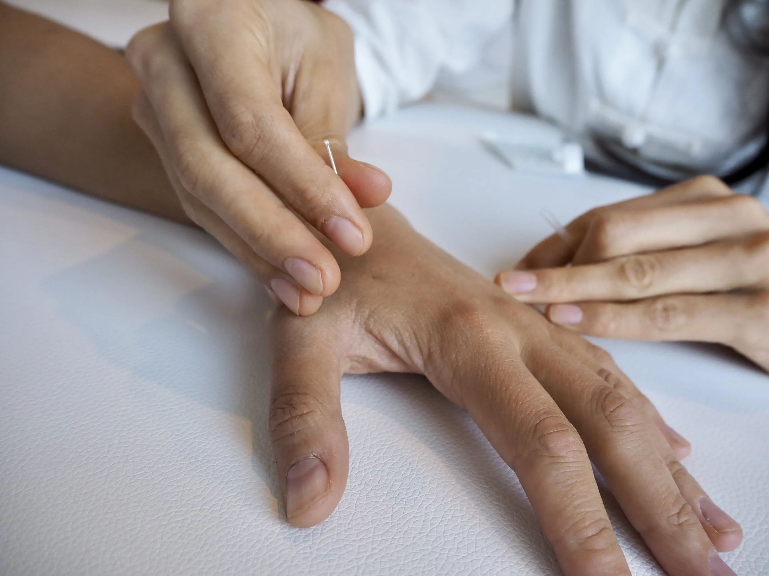 Acupuncture uses fine needles to stimulate specific anatomical areas in the body, affecting local tissues and nervous and circulatory systems. This can help relieve pain while also harmonising the body and addressing various health concerns.