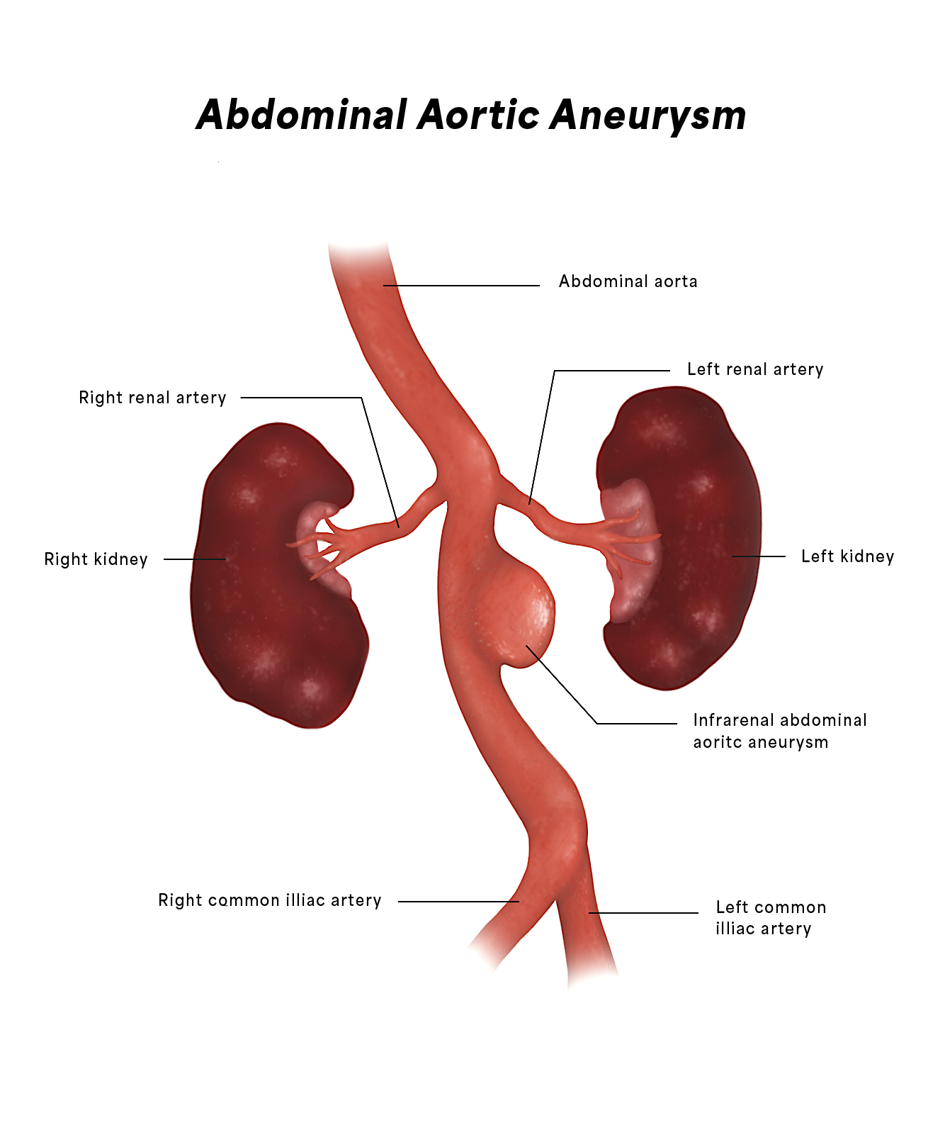 Abdominal Aortic Aneurysm
