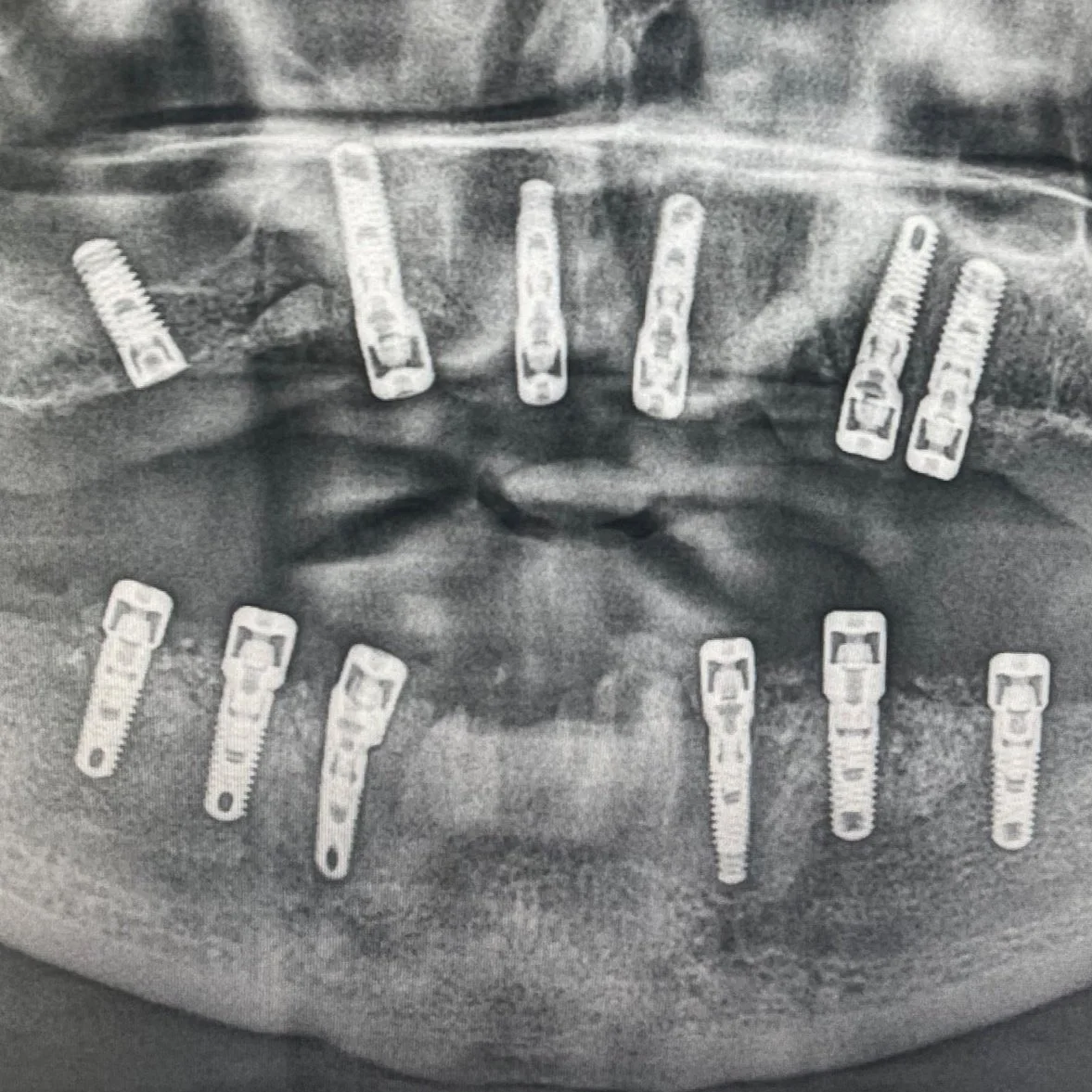 Dentalni snimak koji pokazuje implante ili implantate u obje vilice.