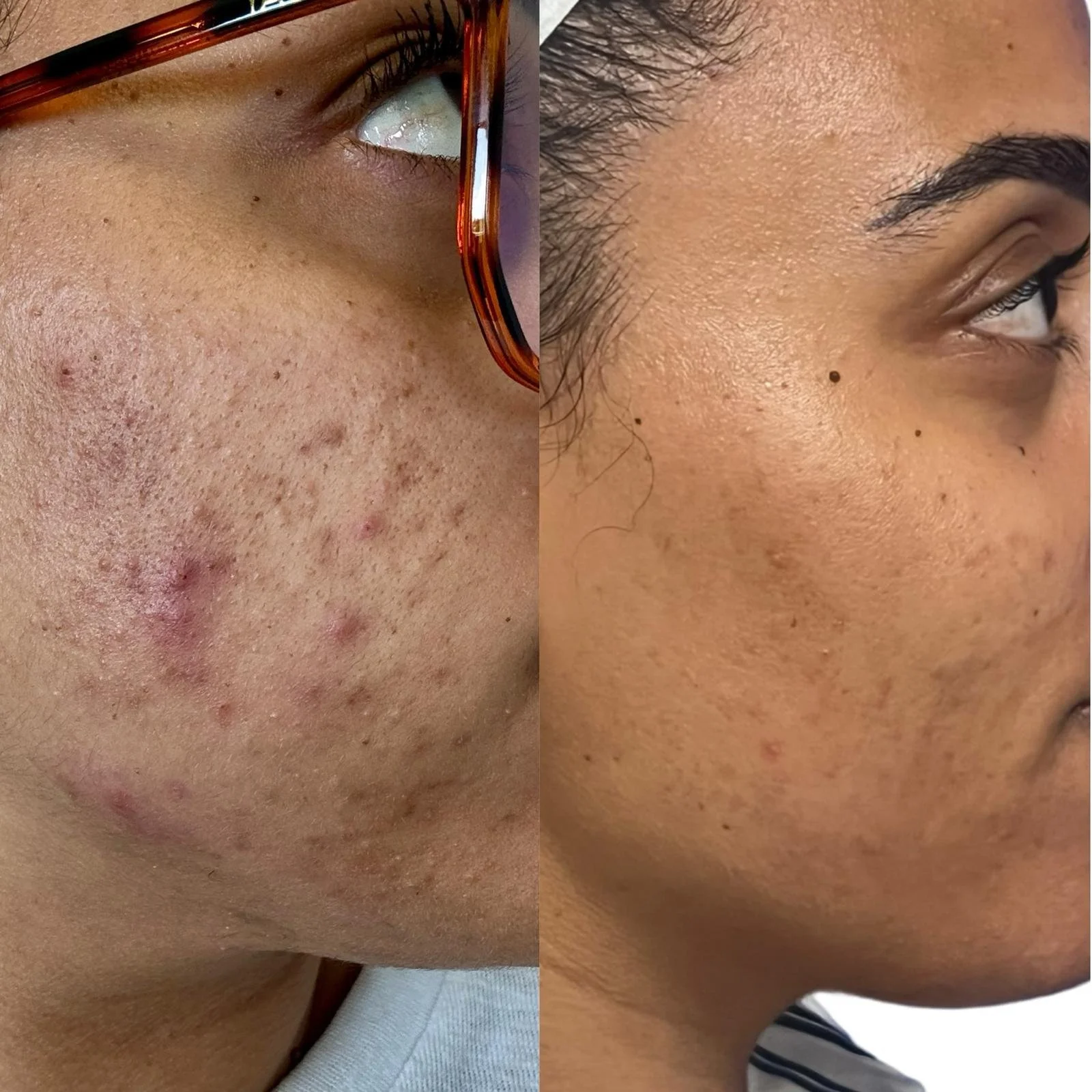 Active acne-acnescarring-low.jpg