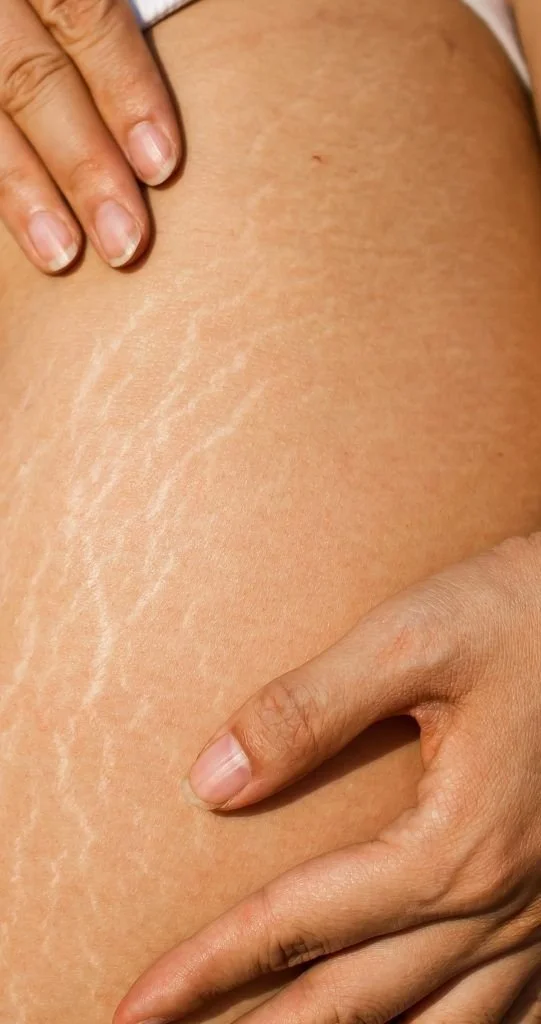 Close-up of a person's skin with visible stretch marks and a hand gently touching the skin.