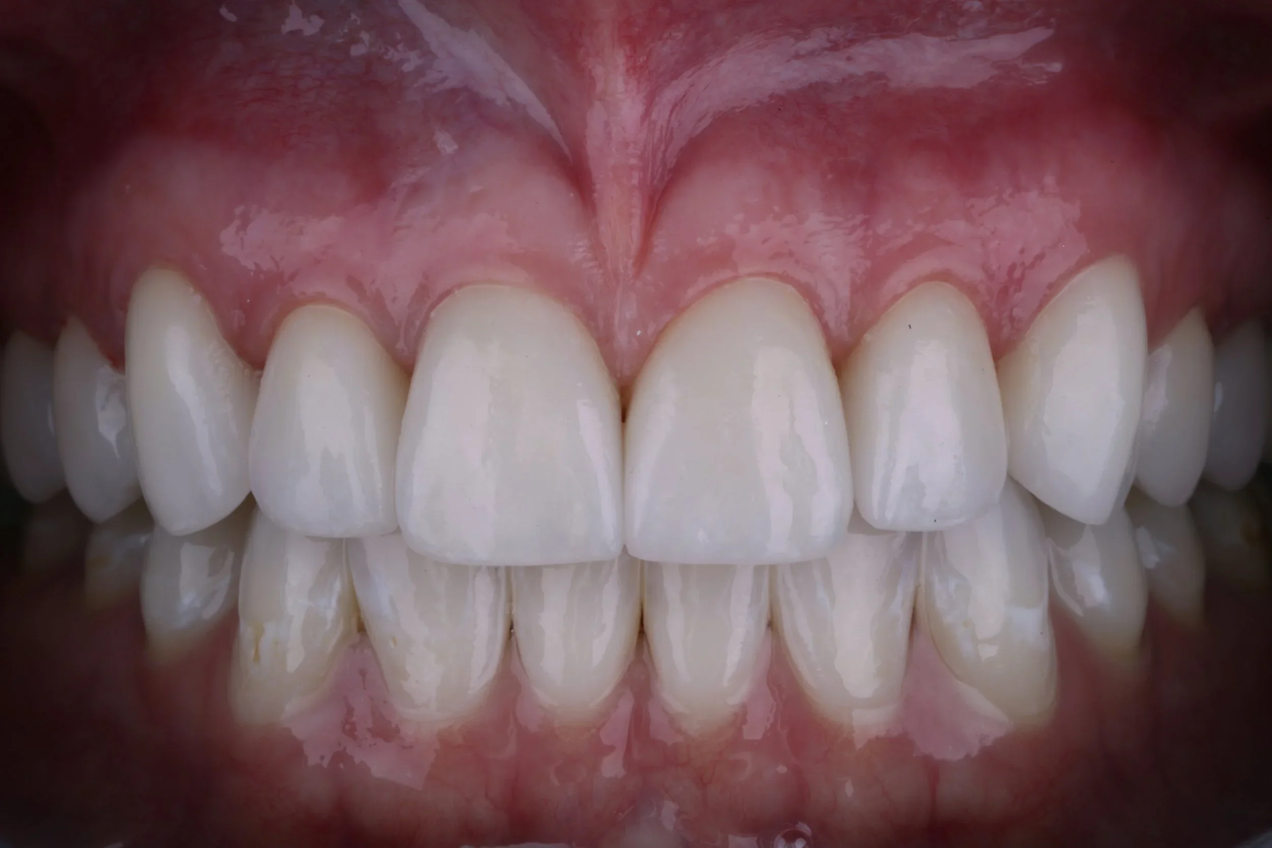 Love at First Trial: Katie’s Trial Smile Veneers