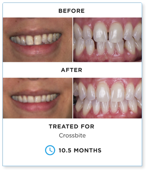 SureSmile_BEFORE-AND-AFTER-2.webp