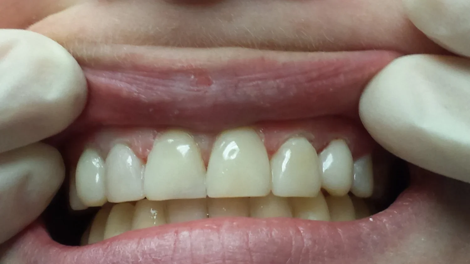 AFTER - Bonnie (Copy) (Copy)