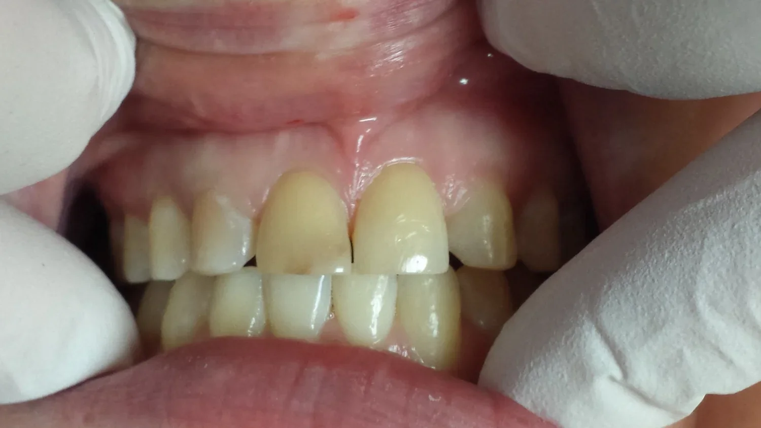 BEFORE - Bonnie (Copy) (Copy)